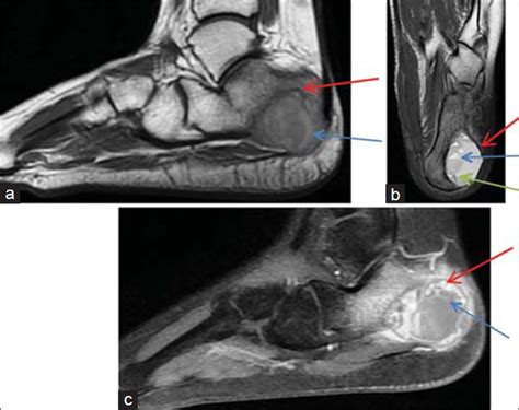 Aneurysmal Bone Cyst of the Calcaneus - Journal of Clinical Imaging Science