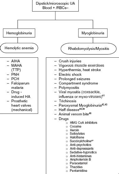 Hemoglobinuria Misidentified as Hematuria: Review of Discolored Urine ...