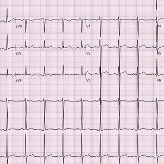 Coronary Angiogram Showing Diffuse Coronary Vasospasm Before Injecting... | Download Scientific ...