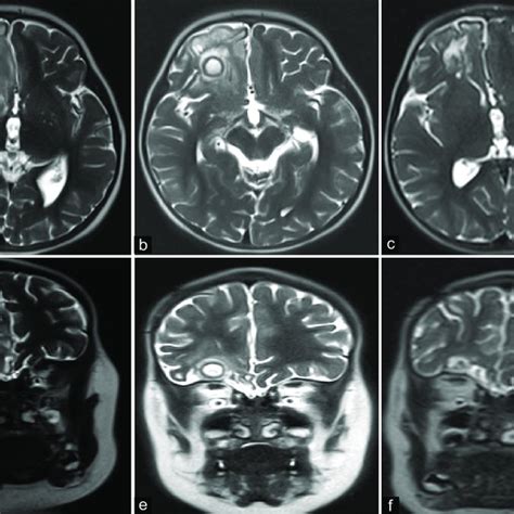 T2 MRI following aspiration and drain placement of the right frontal... | Download Scientific ...