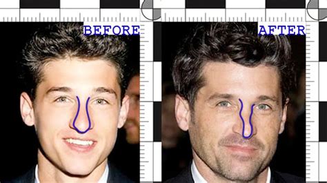 Patrick Dempsey’s Noticeable Nose Job | Rawnsley Plastic Surgery