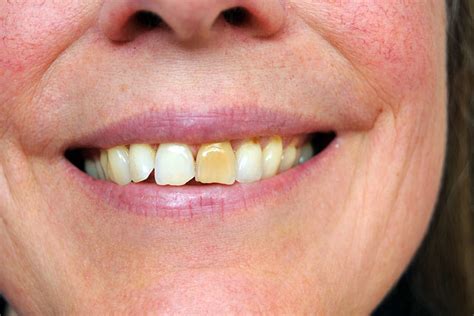 Stained Teeth Causes, Prevention, and Treatment | EVDP