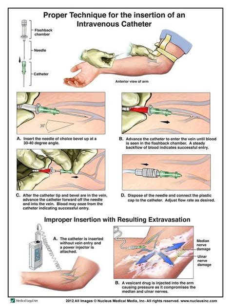 50+ IV Therapy Tips and Tricks: The Ultimate Guide | Nursing school survival, Nursing notes ...