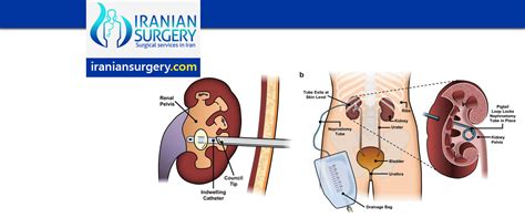 Ureteral Stenting and Nephrostomy procedure in Iran | Iranian Surgery