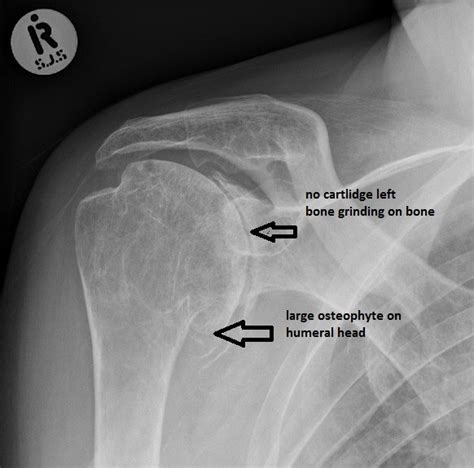 Total Shoulder Replacement for Osteoarthritis: Sports Medicine Doctor ...