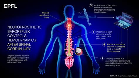 New treatment helps patients with a spinal co | EurekAlert!