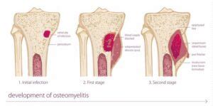 Osteomyelitis: A How to Guide to Management and Treatment