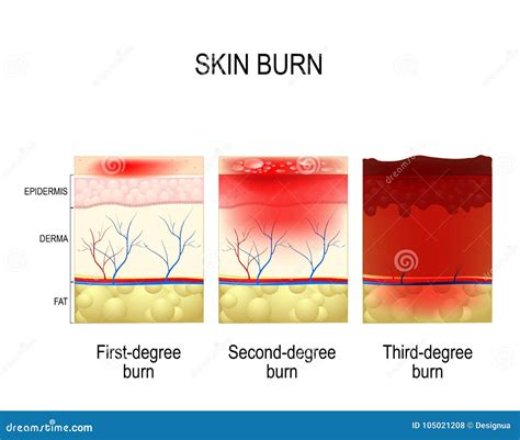 Skin Burn. Three Degrees of Burns Stock Vector - Illustration of flame, poster: 105021208