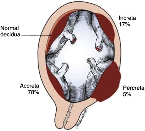 Cureus | Early Accreta and Uterine Rupture in the Second Trimester