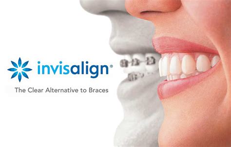 Affordable Invisalign Cost in Austin