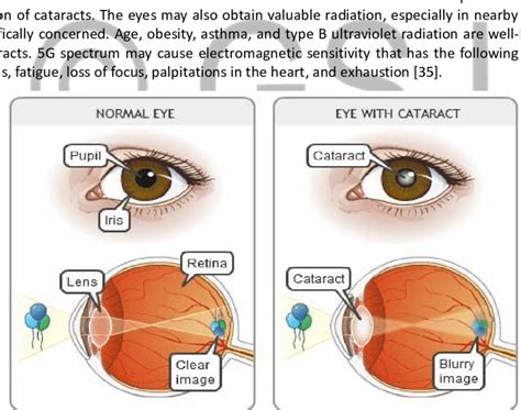 Formation of Cataract | Download Scientific Diagram