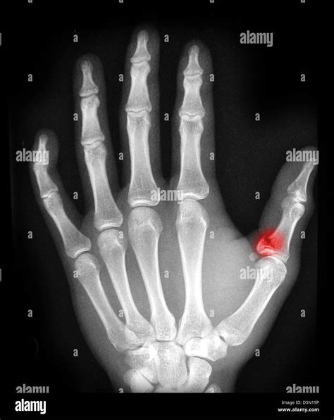 x-ray showing an avulsion fracture of the proximal phalanx of the thumb Stock Photo - Alamy