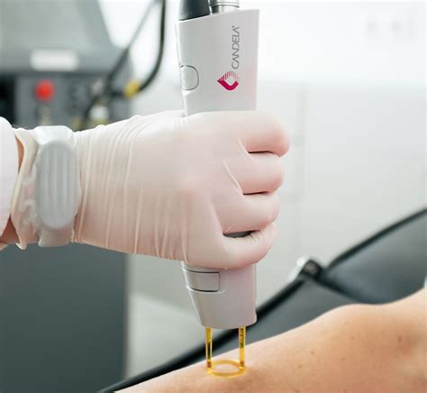 Premium Laser - Uma marca de Depilação a Laser Alexandrite