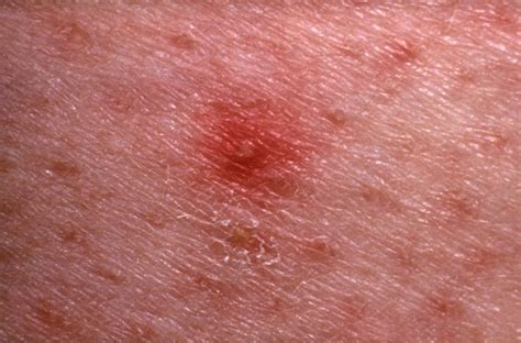 Skin Rash: 7 Causes of Red Spots and Bumps, With Pictures | Allure