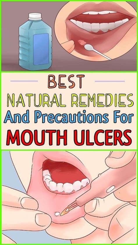 The Best Natural Remedies and Precautions For Mouth Ulcers | Mouth ...