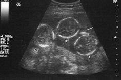 Triplets Ultrasound 19 Weeks | Ultrasound Photos of Twins & Multiples | Triplets, Ultrasound ...