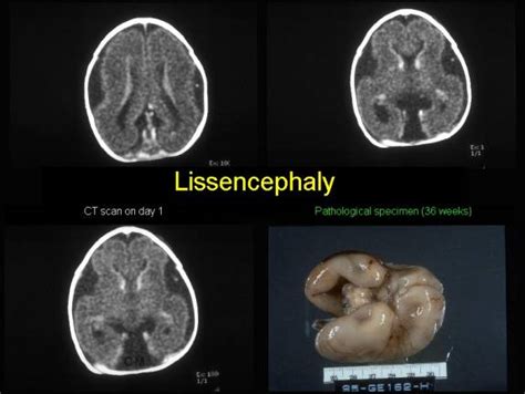 Lissencephaly - Cobblestone Lissencephaly A And B Axial And Coronal T2 ...