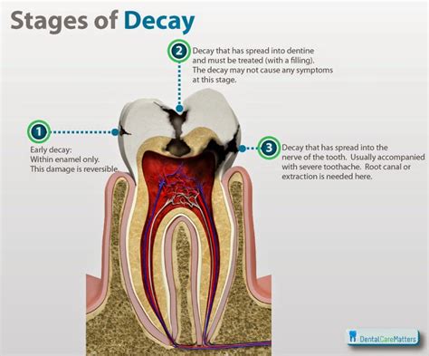 Pediatric Dentist, Bangalore: Root Canal Treatment for Baby Teeth - Pulpectomy