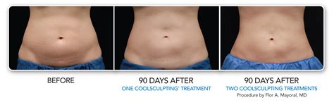 CoolSculpting | Freeze the Fat | Beverly Hills | Los Angeles | West Hollywood