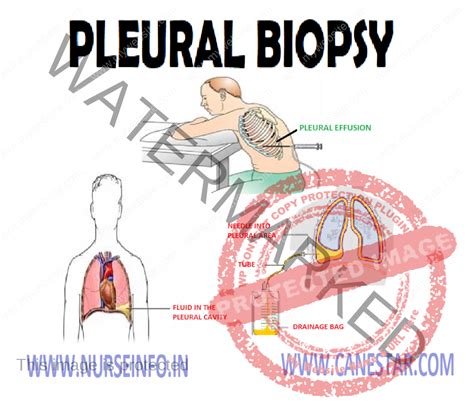 PLEURAL BIOPSY - Nurse Info