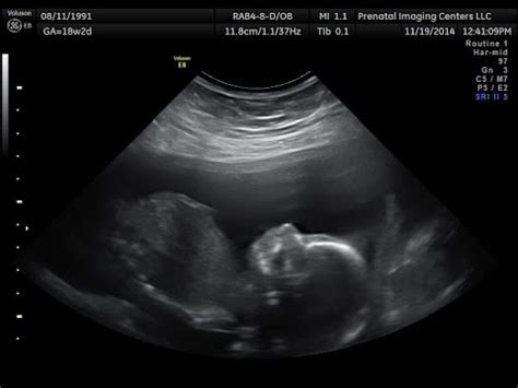 Baby Boy Ultrasound at 18 weeks!! - YouTube