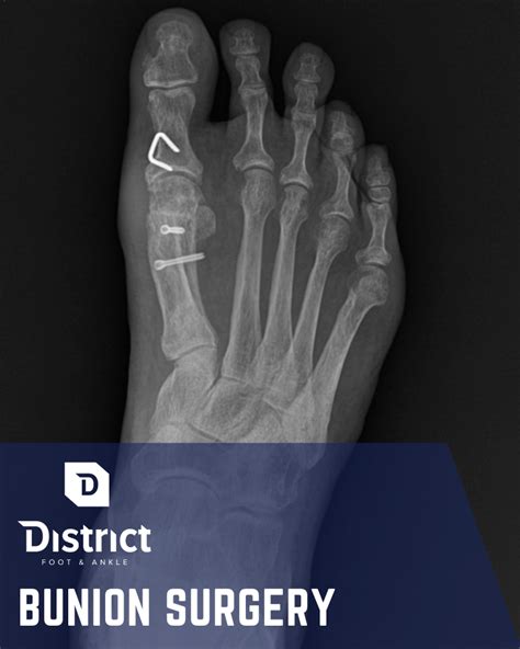 Bunion Surgery | Alexandria VA | Foot Doctor