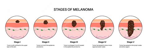 Premium Vector | Melanoma stages poster