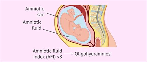 Oligohydramnios: causes, diagnosis and treatment in pregnancy
