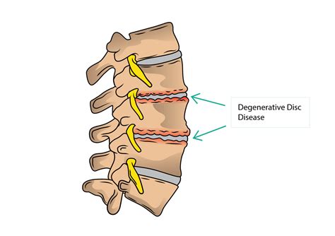 Degenerative Disc Disease | Dr Yu Chao Lee