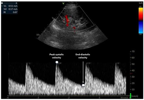 Diagnostics | Free Full-Text | Current Insights into the Significance of the Renal Resistive ...