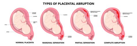 Complications of pregnancy – Illustrated Nursing