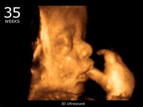 3D Ultrasound: Video Of 3d Ultrasound