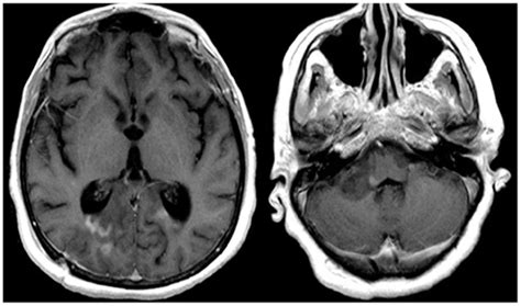 T1W-MRI with contrast shows lesions located in the splenium, pons, and... | Download Scientific ...