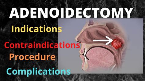 065.Adenoidectomy #adenotonsillectomy #surgeryeducation - YouTube