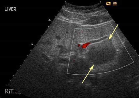 RiT radiology: Focal Fat Sparing