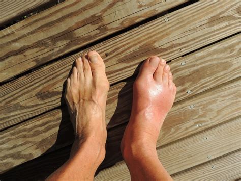 Swollen Toes: Everything You Need To Know!