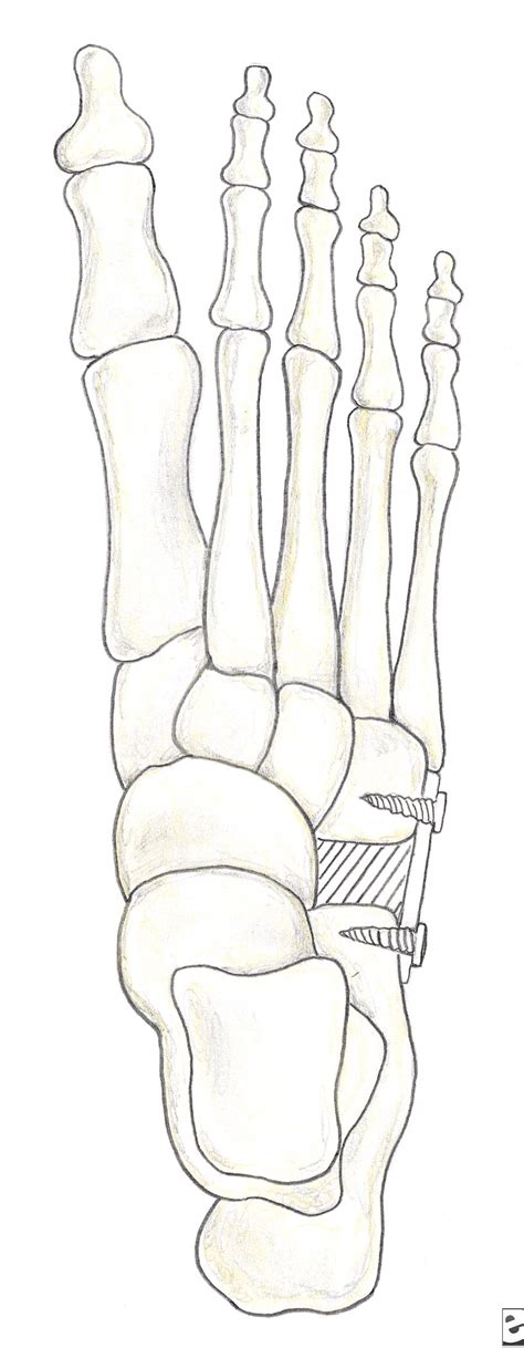 talonavicular joint with retractor