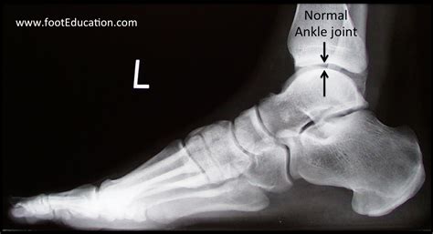Ankle Arthritis - FootEducation