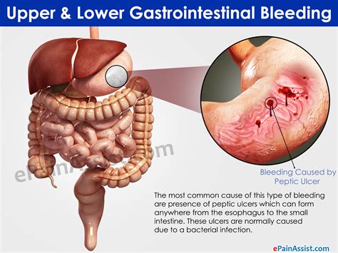 Upper & Lower Gastrointestinal Bleeding|Treatment|Home Remedies|Causes