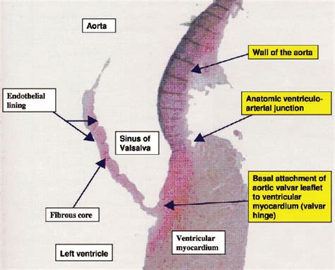 Anatomy and Function of Normal Aortic Valvular Complex | IntechOpen