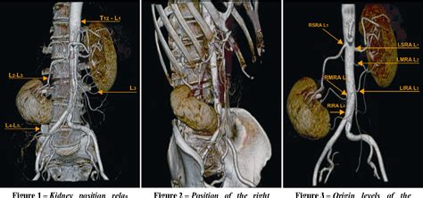 Ectopic kidney with malrotation and bilateral multiple arteries ...