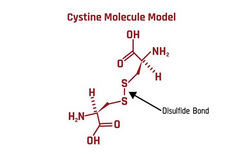 Cystine Kidney Stones- The Nastiest of All | Stone Relief