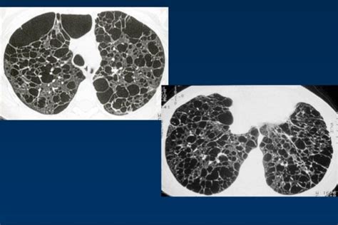 Cystic lung diseases