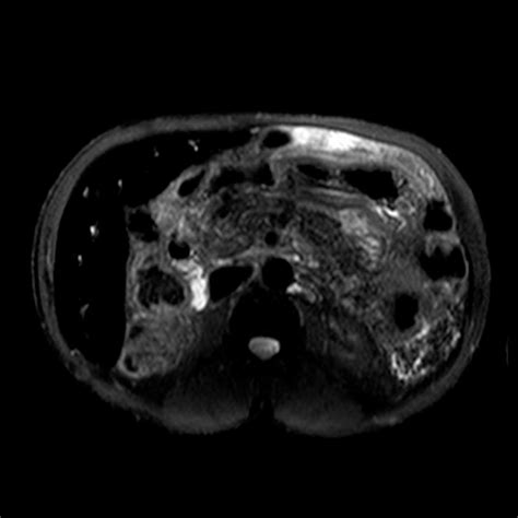 Hemosiderosis in the Liver in a patient with sickle cell anemia ...