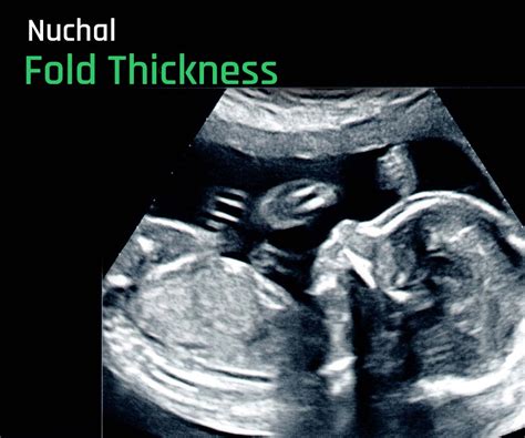 Nuchal Fold Thickness: Normal or abnormal? Expert insights in 2023