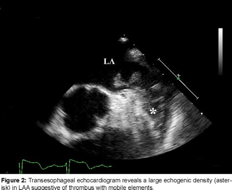 Figure 2 from Surgical Removal of Left Atrial Appendage Thrombus in a ...