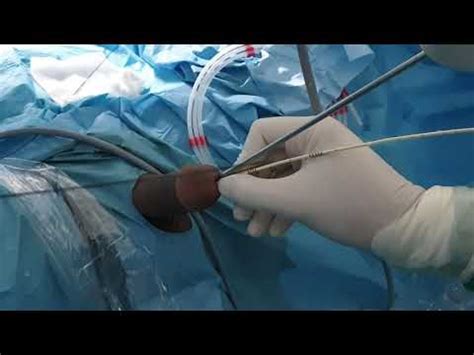 Trick to insert the DJ stent using the ureteroscope only - YouTube