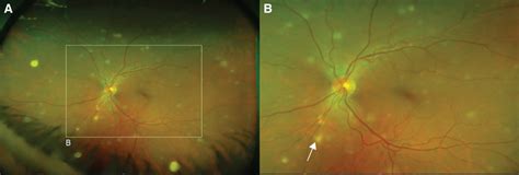 Multifocal Choroiditis with Panuveitis | Ento Key