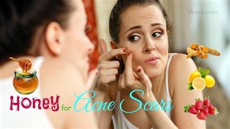 Top 11 tips on how to use honey for acne scars treatment