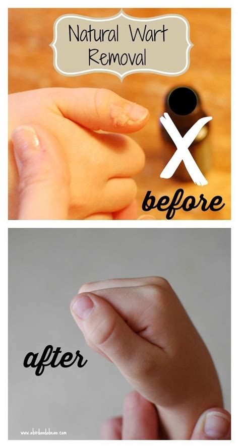 How To Remove Warts On Elbow - HOWTOREMVO